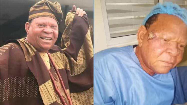 ANTP Denies Cancer Rumours as Veteran Actor Adewale Elesho Successfully Undergoes Facial Surgery