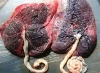 Human Placenta Sheets Could Help Men Regain Erections After Prostate Cancer Surgery