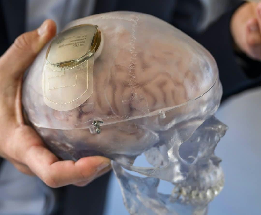 China Approves First Commercial Brain Implant to Help Paralysed Patients Regain Hand Movement
