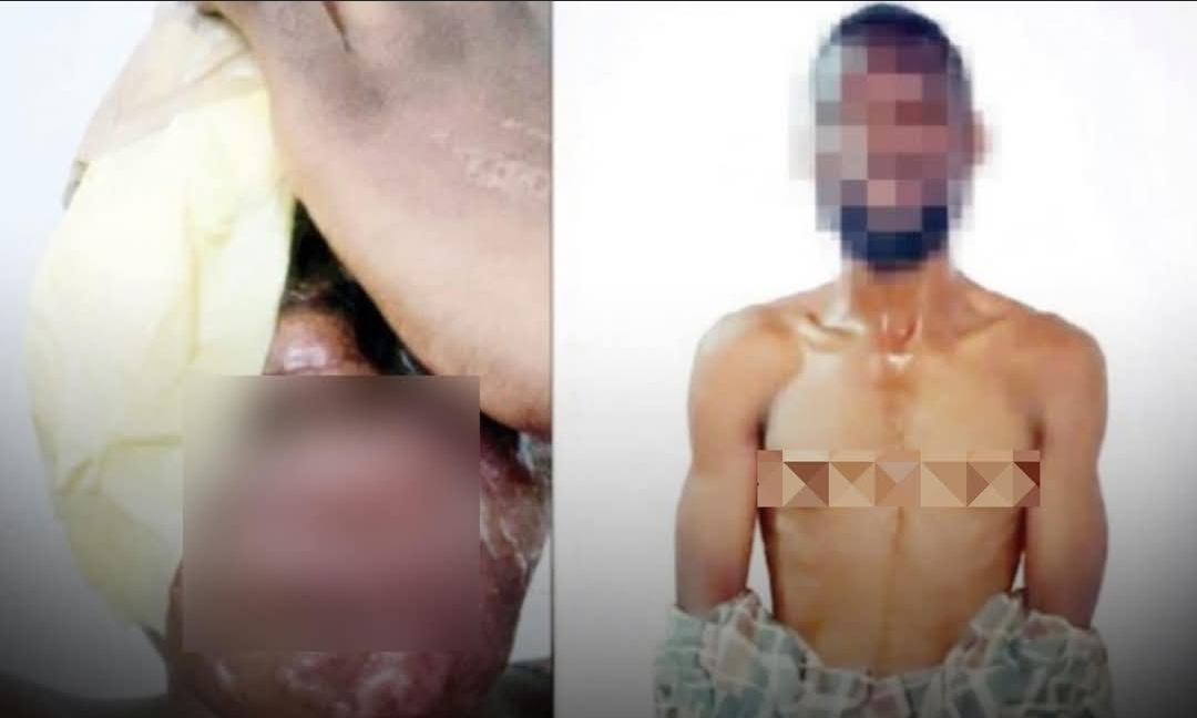 “I Was Paid ₦500,000” — Suspect Confesses After Brutal Acid Attack on Spa Worker